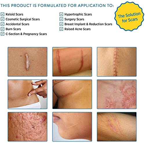 Soft Silicone Scar Sheets Strips for Surgery, Injury, Burns D269075