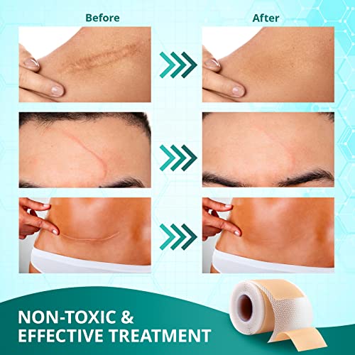 Silicone Scar Sheets for Surgical, Keloid, and C-Section Scars Z84648