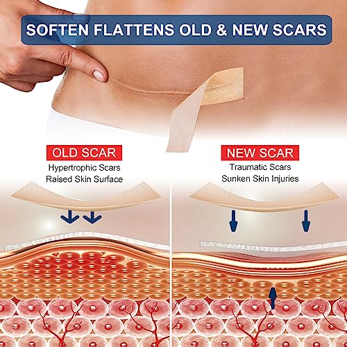 Silicone Scar Sheets Roll for C-Section, Surgery, Burn, Keloid, Acne I990