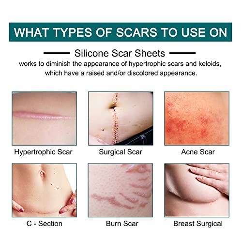 Silicone Scar Sheets Roll for C-Section, Surgery, Burn, Keloid, Acne I990