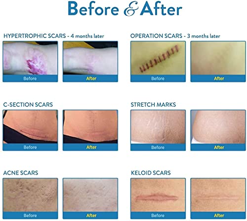 Soft Silicone Scar Sheets Strips for Surgery, Injury, Burns D269075