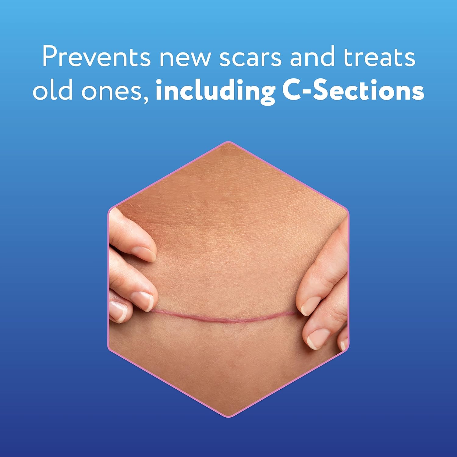 Silicone Scar Sheets for C-Section, Reusable, 4 Sheets U386