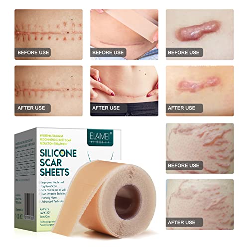 Silicone Scar Sheets Roll for C-Section, Surgery, Burn, Keloid, Acne I990